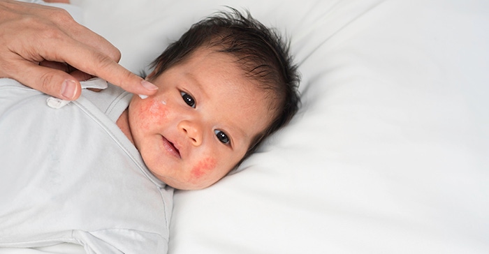 Dermatitis Atopik Pada Bayi Kenali Penyebab Dan Perawatannya